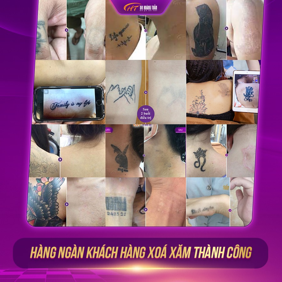 Xoá xăm bằng laser bao nhiêu tiền?